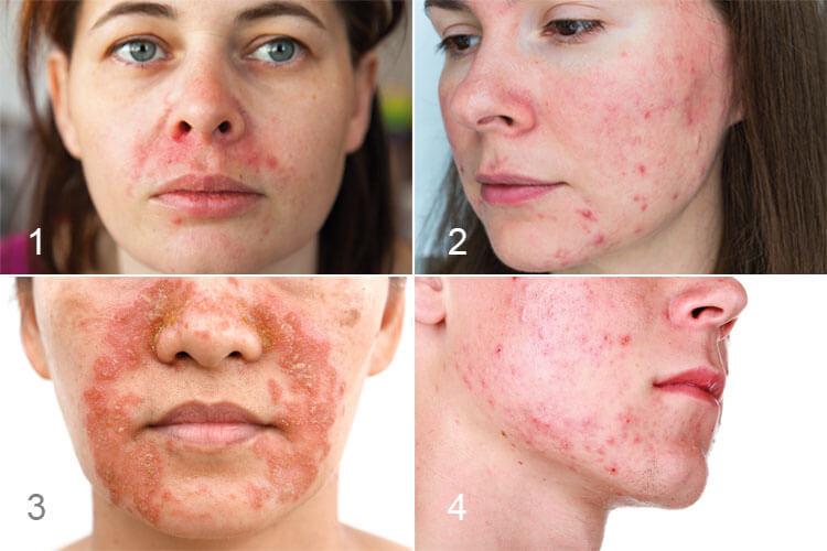 Diese Dermatosen knnen dem Gesicht blhen